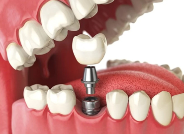 Dental Implants preet vihar