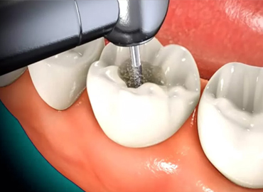 Root Canal laxmi nagar